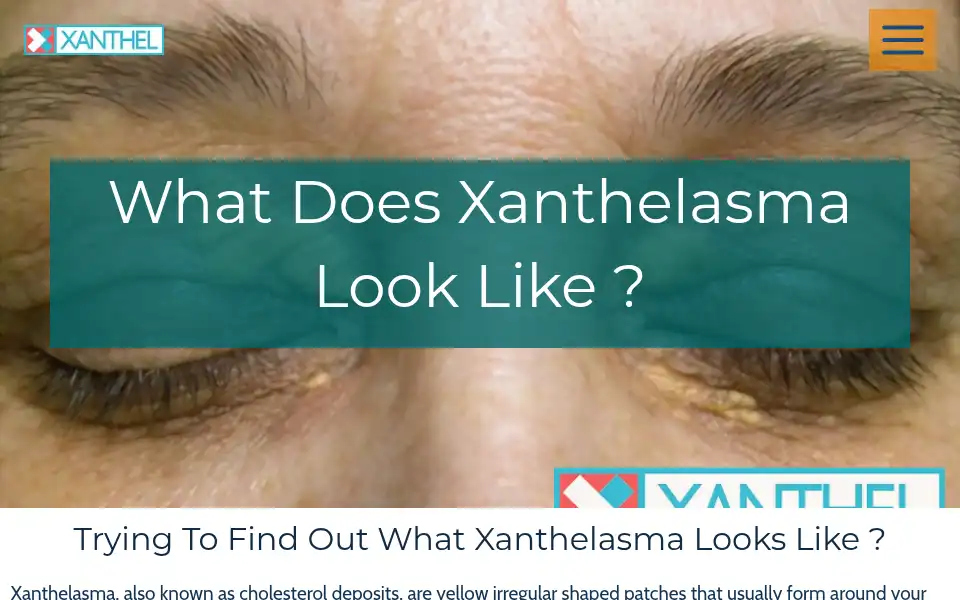 Screenshot of xanthelasmatreatment.com